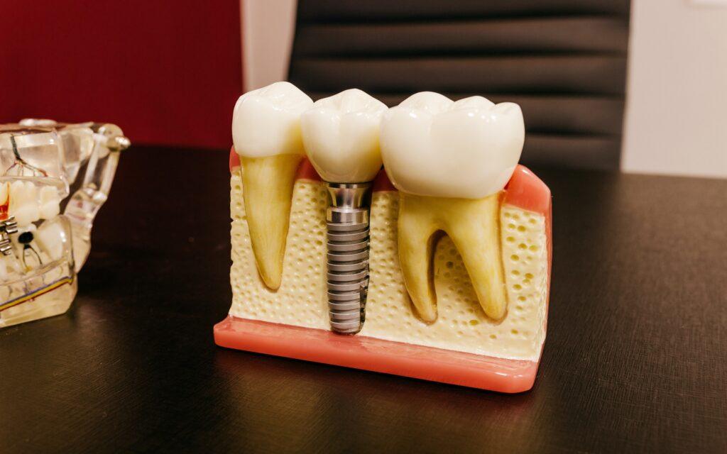 A Major Problem in Dental Implant’s